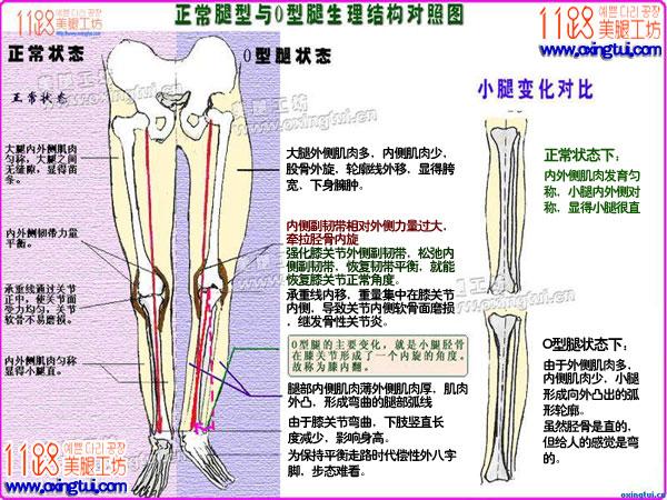 o型腿与正常腿型骨骼,肌肉对比图