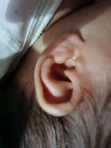 宝宝耳朵外有很多分泌物,还有点渗水.有没有亲晓得是怎么回事呀?