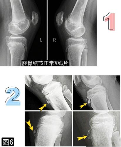 引起膝前痛的胫骨结节骨软骨炎你会诊治吗