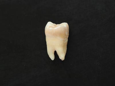 牙齿龋坏图片