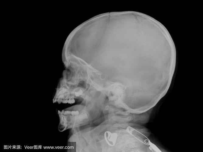 婴儿头骨的x光图像